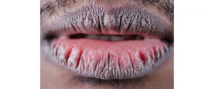 Madu dalam Lip Balm: Kesan dan Manfaat