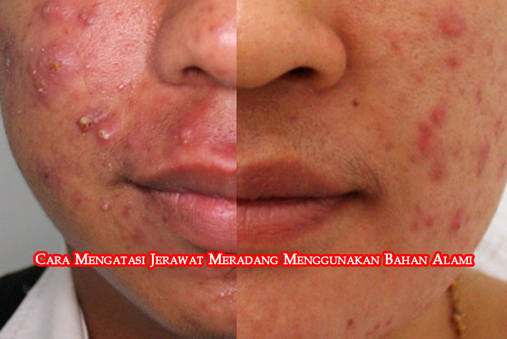 Masker Aloe Vera & Madu Untuk Jerawat Yang Meradang: Rahsia Perawatan Alami